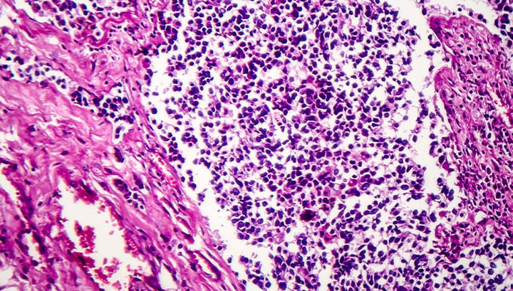 Clinical Outcomes of PD-1/PD-L1 Inhibitors Among Patients With Advanced or Metastatic Non-Small Cell Lung Cancer Image